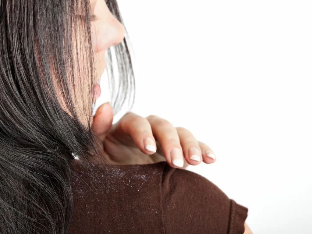 woman with dandruff on her shoulder