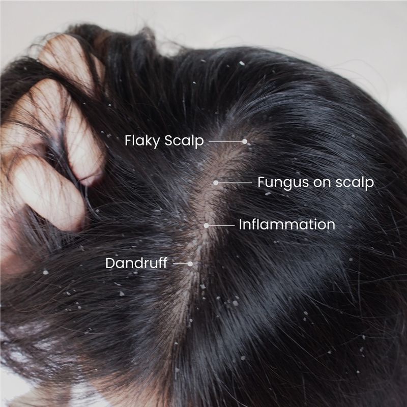 Treat Dandruff