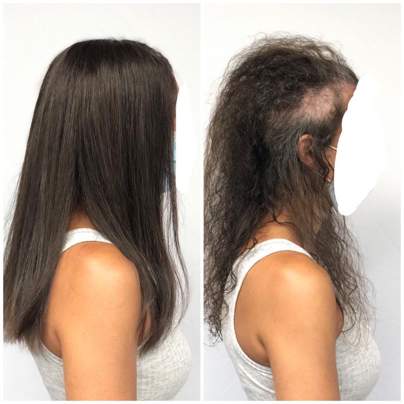 Trichotillomania