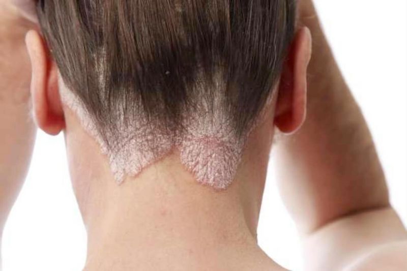 Scalp Infections