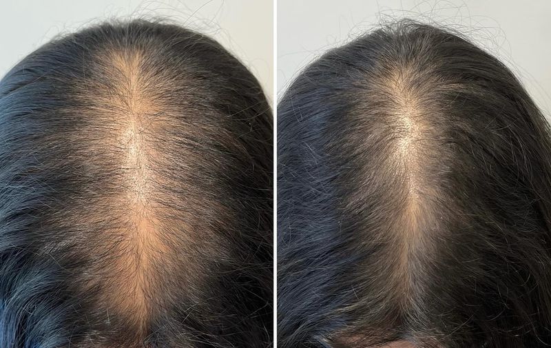 Androgenetic Alopecia