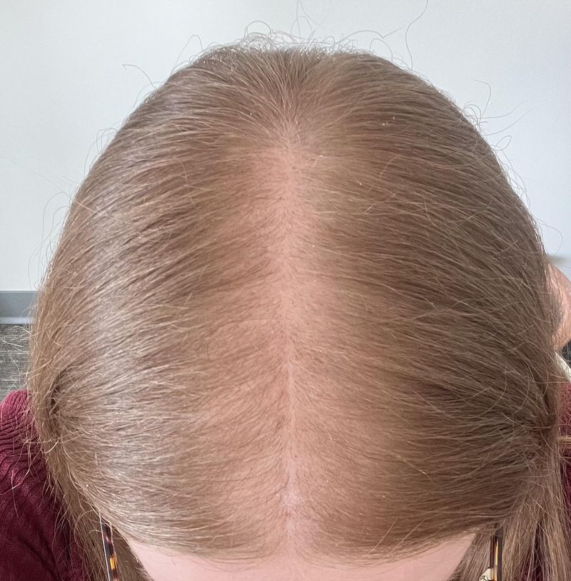 Visible Scalp Embarrassment