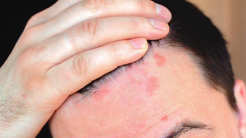 Potential Scalp Irritation Risk