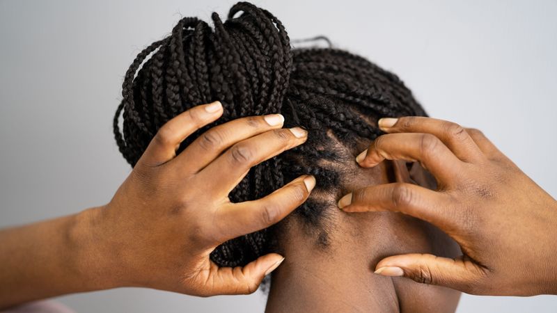 Itchy Scalp Relief