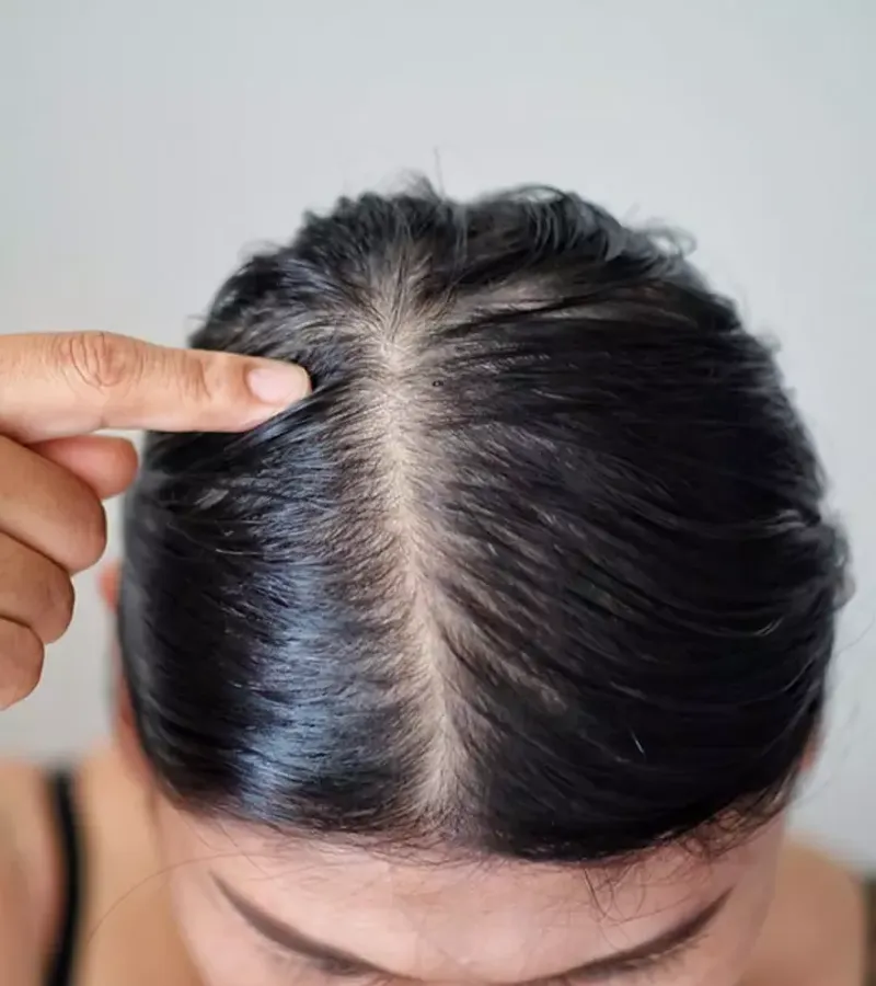 Triggers Scalp Overcompensation