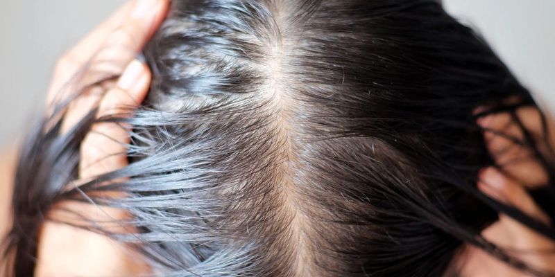 PCOS Creates Hair Havoc Inside And Out