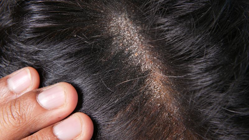 Prevents Dandruff Naturally