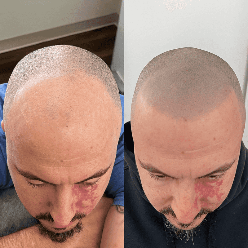 Scalp Micropigmentation