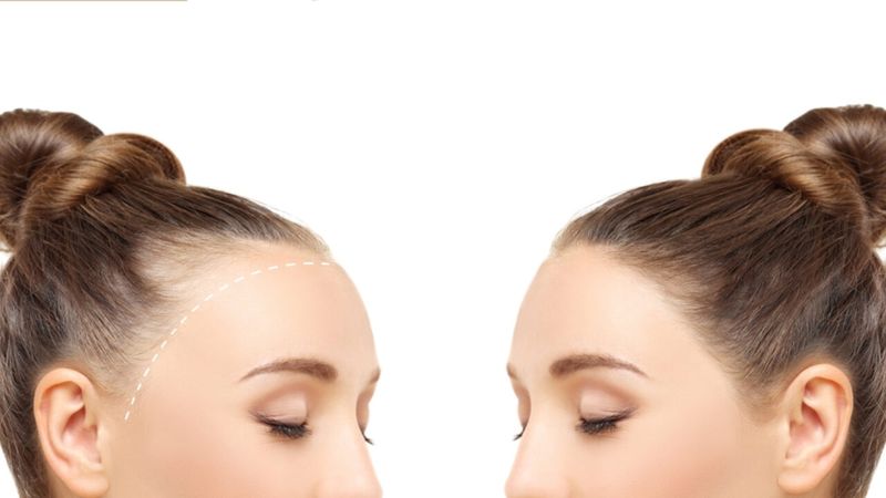 Consider Hair-Friendly HRT Options