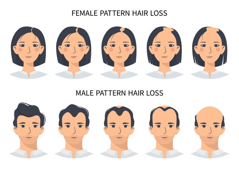 Male Pattern Baldness Has Hormonal Roots