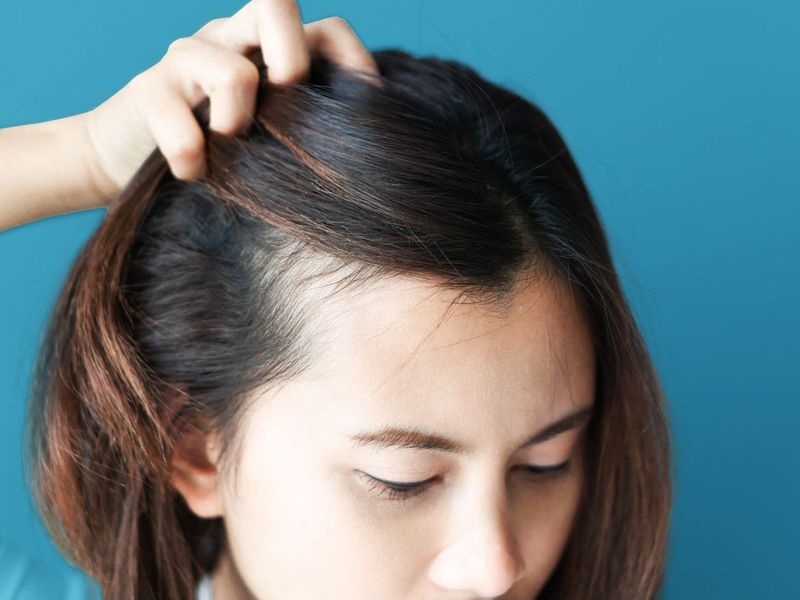 Stress of Travel Triggers Scalp Issues