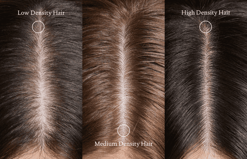 Your Hair Density Wasn't Evaluated