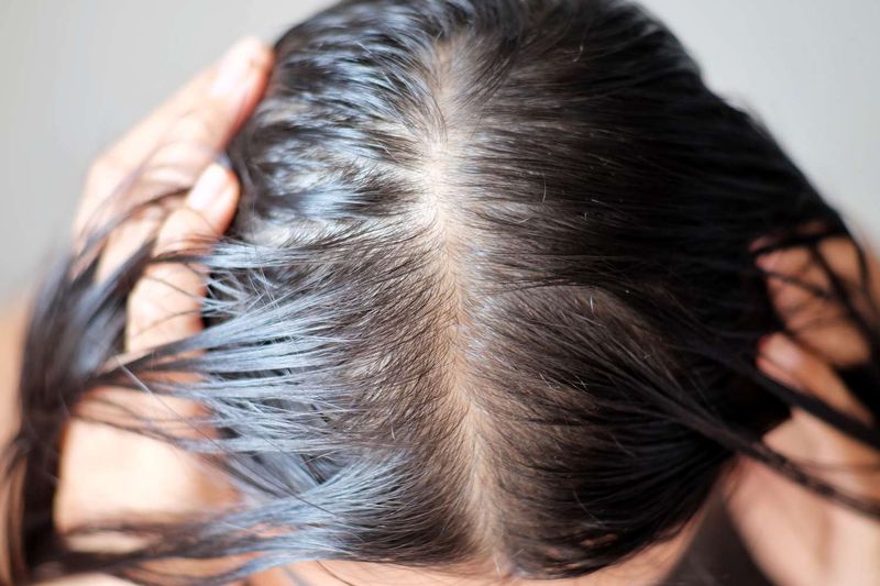 Only Men Experience Significant Hair Loss