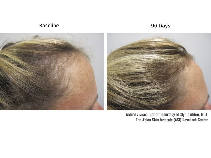 Supplements Always Fix Hair Thinning