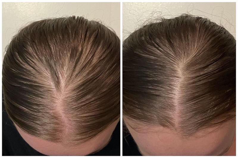 Minoxidil Works—But Timing Is Everything
