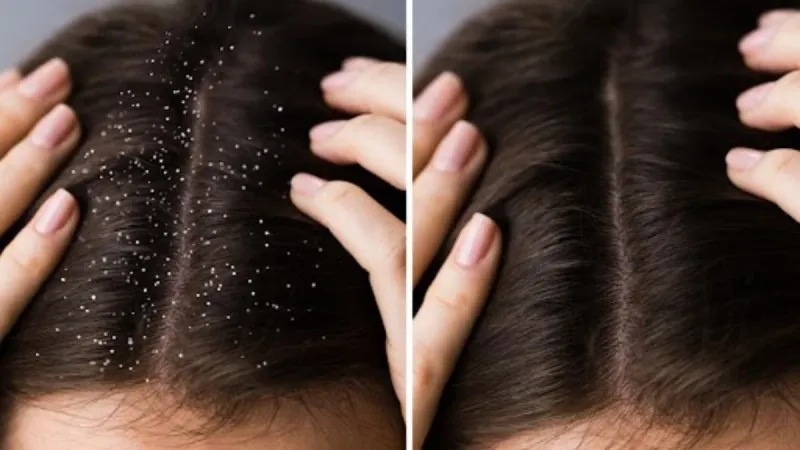 Dandruff Demolition