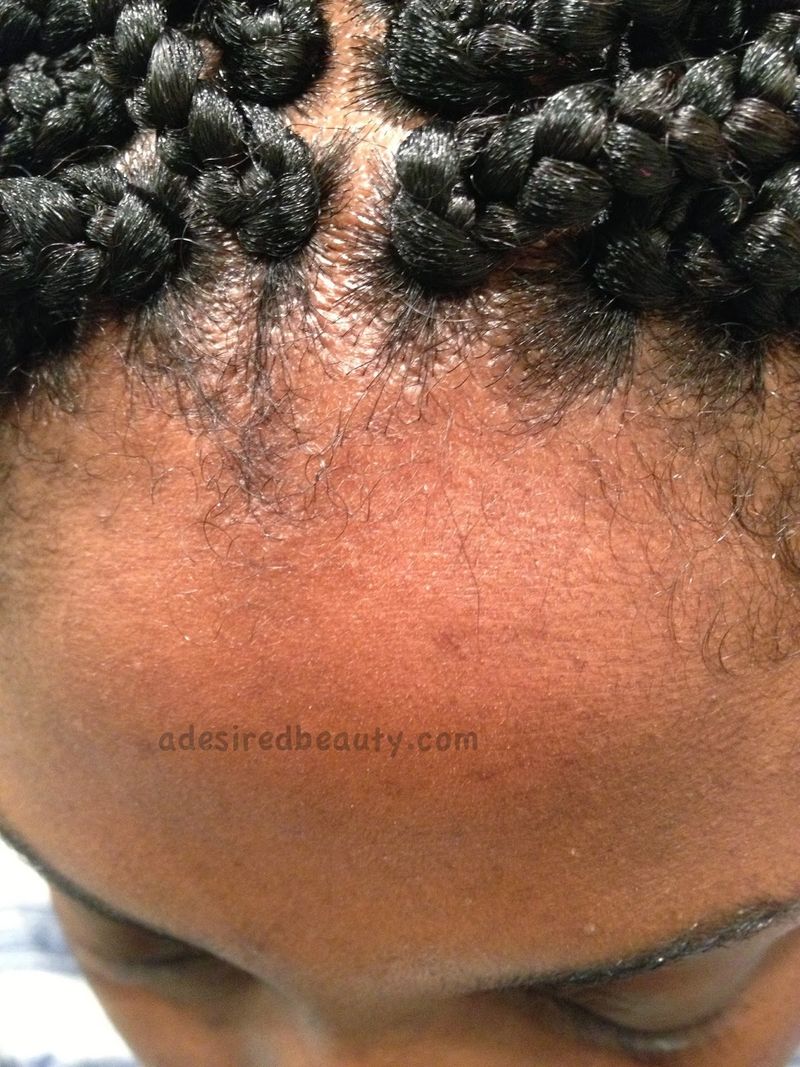 Too-Tight Box Braids