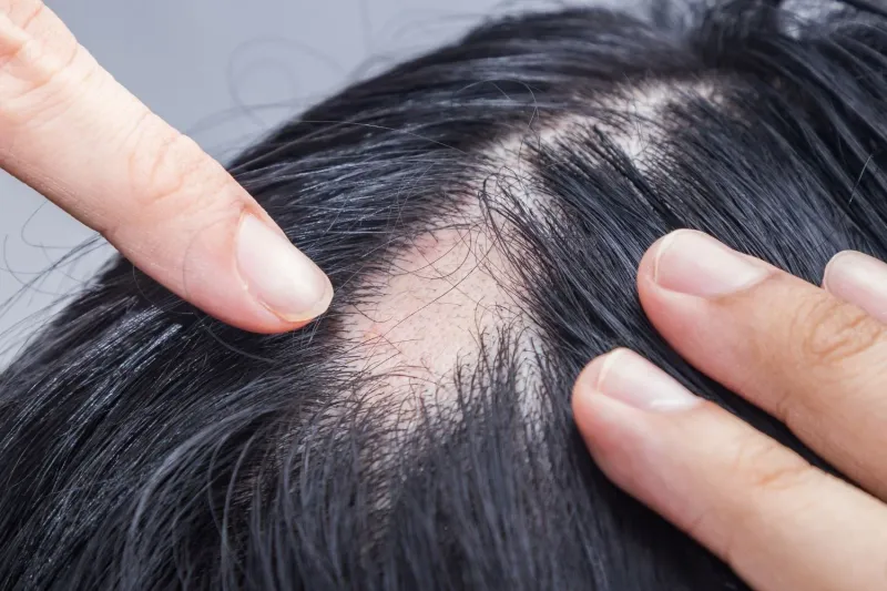 Overly Tight Lace Frontal Weaves