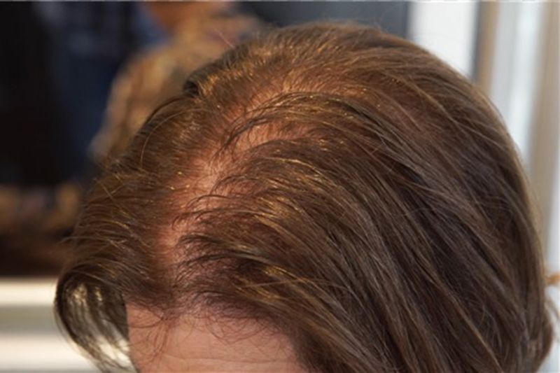Thinning Troubles