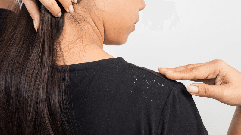Dandruff Dilemma
