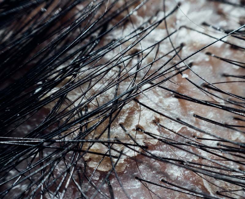 Scalp Surprise Party