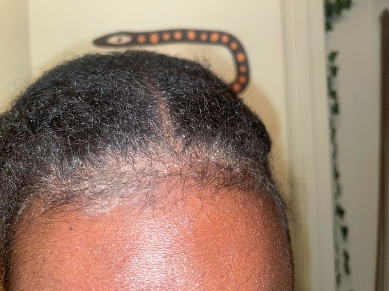 Scalp Flakiness Increases